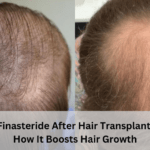 finasteride after hair transplant