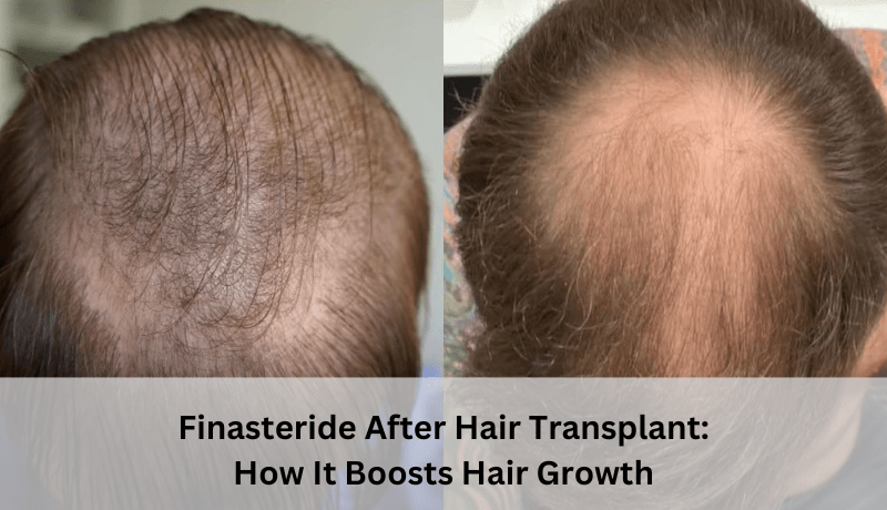 finasteride after hair transplant