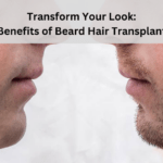 Beard hair transplant Benefits